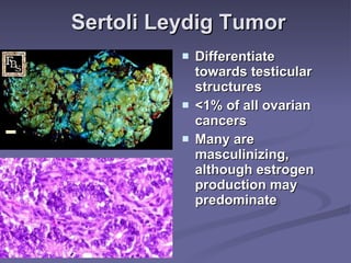 Sertoli Leydig Tumor Differentiate towards testicular structures <1% of all ovarian cancers Many are masculinizing, although estrogen production may predominate 