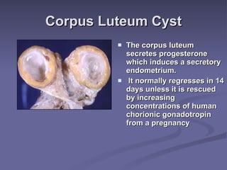 Corpus Luteum Cyst The corpus luteum secretes progesterone which induces a secretory endometrium. It normally regresses in 14 days unless it is rescued by increasing concentrations of human chorionic gonadotropin from a pregnancy  