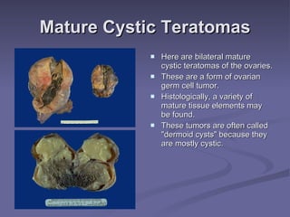 Mature Cystic Teratomas Here are bilateral mature cystic teratomas of the ovaries.  These are a form of ovarian germ cell tumor.  Histologically, a variety of mature tissue elements may be found.  These tumors are often called "dermoid cysts" because they are mostly cystic. 