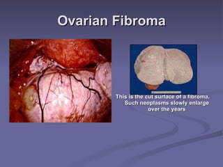 Ovarian Fibroma This is the cut surface of a fibroma. Such neoplasms slowly enlarge over the years 