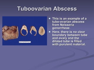 Tuboovarian Abscess This is an example of a tubo-ovarian abscess from Neisseria gonorrheae.  Here, there is no clear boundary between tube and ovary and the dilated tube is filled with purulent material. 