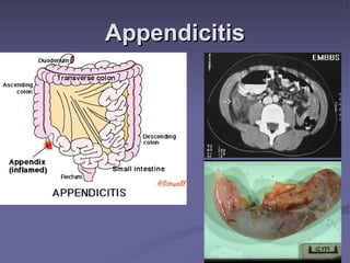 Appendicitis 