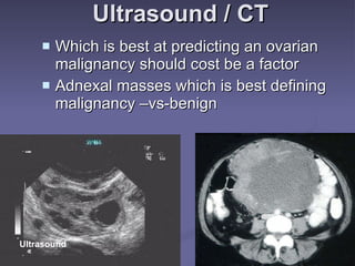 Ultrasound / CT Which is best at predicting an ovarian malignancy should cost be a factor Adnexal masses which is best defining malignancy –vs-benign Ultrasound 