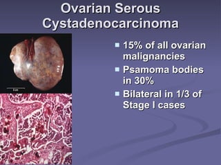 Ovarian Serous Cystadenocarcinoma 15% of all ovarian malignancies Psamoma bodies in 30% Bilateral in 1/3 of Stage I cases 