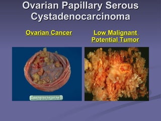 Ovarian Papillary Serous Cystadenocarcinoma Ovarian Cancer     Low Malignant    Potential Tumor 