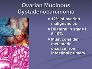 Ovarian Mucinous Cystadenocarcinoma 12% of ovarian malignancies Bilateral in stage I 5-10% Must consider metastatic disease from intestinal primary 