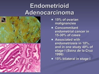 Endometrioid Adenocarcinoma 15% of ovarian malignancies Concommitant endometrial cancer in 15-30% of cases Associated with endometriosis in 10%, and in one study 40% of stage I (Sainz de la Cruz 1996) 15% bilateral in stage I 