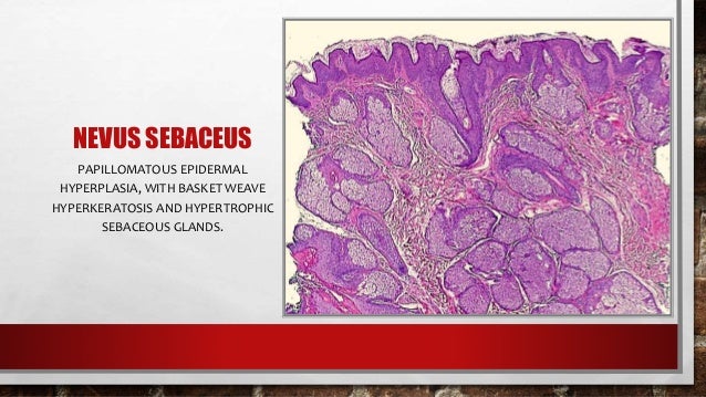 Nevus sebaceous and nevus sebaceous syndrome - uptodate.com