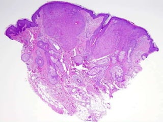 NUMEROUS HORN CYST IN THE DERMIS. CYST
LINED BY EOSINOPHILIC CELLS , CONTAIN
KERATIN.
 