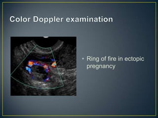 • Ring of fire in ectopic
  pregnancy
 