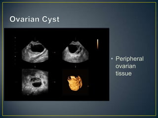 • Peripheral
  ovarian
  tissue
 