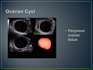 • Peripheral
  ovarian
  tissue
 