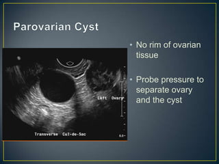 • No rim of ovarian
  tissue

• Probe pressure to
  separate ovary
  and the cyst
 