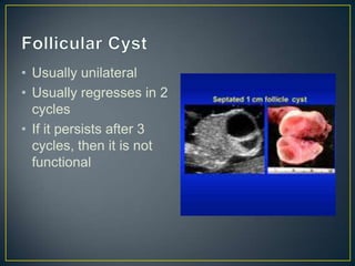 • Usually unilateral
• Usually regresses in 2
  cycles
• If it persists after 3
  cycles, then it is not
  functional
 