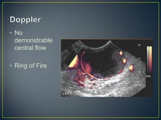 • No
  demonstrable
  central flow

• Ring of Fire
 