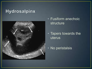 • Fusiform anechoic
  structure

• Tapers towards the
  uterus

• No peristalsis
 