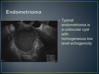 • Typical
  endometrioma is
  a unilocular cyst
  with
  homogeneous low
  level echogenicity
 