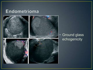 • Ground glass
  echogenicity
 