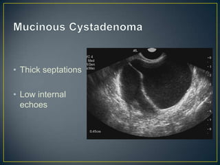 • Thick septations

• Low internal
  echoes
 
