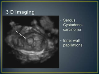 • Serous
  Cystadeno-
  carcinoma

• Inner wall
  papillations
 