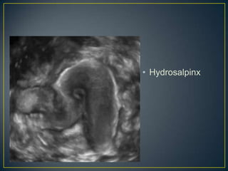• Hydrosalpinx
 