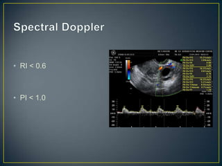 • RI < 0.6



• PI < 1.0
 