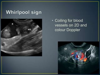 • Coiling for blood
  vessels on 2D and
  colour Doppler
 