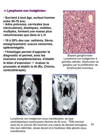 Lymphome non hodgkinien: Survient à tout âge, surtout homme entre 50-70 ans; Adns précoces, cervicales (sus claviculaires), élastiques, mobiles, multiples, formant une masse plus volumineuses que dans le L.H. 10 à 20% des cas: asthénie, fièvre, amaigrissement, sueurs nocturnes, splénomégalie. l’histologie permet d’apporter le diagnostic et permet, avec les examens complémentaires, d’établir le bilan d’extension     évaluer le pronostic et établir le ttt (Rx, Chimio, corticothérapie). Biopsie ganglionnaire: Lymphome non hodgkinien à grandes cellules. Destruction du ganglion par la prolifération de lymphocytes tumoraux. Lymphome non hodgkinien sous mandibulaire, de type centroblastique centrocytaire (femme de 52 ans) : TDM cervical axial (A) et corona! (B) montrant une masse de densité homogène, très bien délimitée, située devant et à l'extérieur dela glande sous-mandibulaire. 
