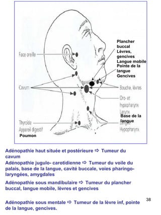Adénopathie haut située et postérieure     Tumeur du   cavum Adénopathie jugulo- carotidienne     Tumeur du   voile du palais, base de la langue, cavité buccale, voies pharingo-laryngées, amygdales  Adénopathie sous mentale     Tumeur de la lèvre inf, pointe de la langue, gencives.  Adénopathie sous mandibulaire     Tumeur du plancher buccal, langue mobile, lèvres et gencives  Base de la langue Pointe de la langue Gencives Plancher buccal Lèvres, gencives Langue mobile Poumon 