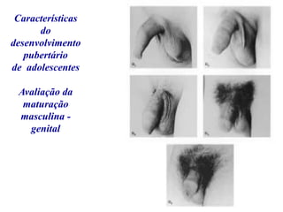 Características
do
desenvolvimento
pubertário
de adolescentes
Avaliação da
maturação
masculina -
genital
 