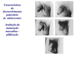 Características
do
desenvolvimento
pubertário
de adolescentes
Avaliação da
maturação
masculina -
pilificação
 
