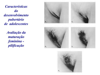 Características
do
desenvolvimento
pubertário
de adolescentes
Avaliação da
maturação
feminina -
pilificação
 