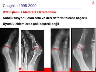 8
Coughlin 1995-2009
DYD İşlemi + Metatars Osteotomisi
Sublüksasyonu olan orta ve ileri deformitelerde başarılı
Uyumlu ekl...