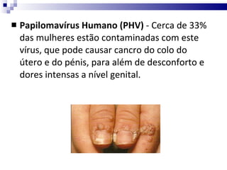 Papilomavírus Humano (PHV)  - Cerca de 33% das mulheres estão contaminadas com este vírus, que pode causar cancro do colo do útero e do pénis, para além de desconforto e dores intensas a nível genital. 