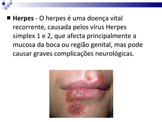 Herpes  - O herpes é uma doença vital recorrente, causada pelos vírus Herpes simplex 1 e 2, que afecta principalmente a mucosa da boca ou região genital, mas pode causar graves complicações neurológicas. 
