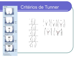 Critérios de Tunner
 