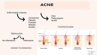 ACNE
Enfermedad cutanea
Comedones
Pápulas
Pustulas
Nódulos
Quistes
Cara
Parte superior
de MS
Obstrucción
No inflamatoria Inflamatoria
UNIDAD PILOSEBACEA
FISIOPATOLOGIA
 