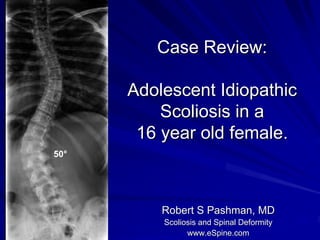 Case Review:

      Adolescent Idiopathic
          Scoliosis in a
       16 year old female.
50°




          Robert S Pashman, MD
          Scoliosis and Spinal Deformity
                www.eSpine.com
 