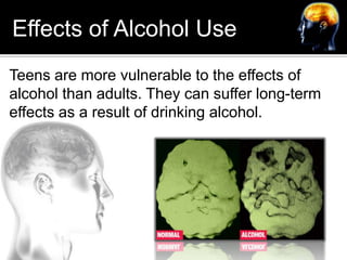 Effects of Alcohol Use<br />Teens are more vulnerable to the effects of alcohol than adults. They can suffer long-term eff...