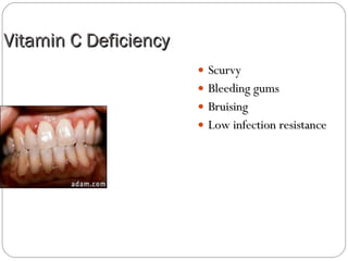 Vitamin C Deficiency Scurvy Bleeding gums Bruising Low infection resistance 