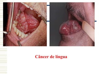 Câncer de língua
 