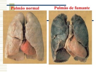 Pulmão normal   Pulmão de fumante
 
