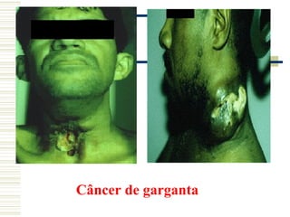 Câncer de garganta
 