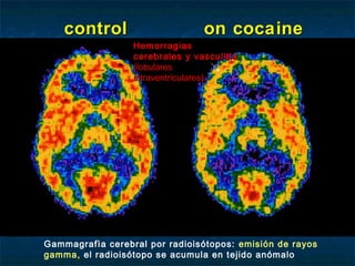control                      on cocaine
                  Hemorragias
                  cerebrales y vasculitis
                  (lobulares
                  intraventriculares).




Gammagrafìa cerebral por radioisótopos: emisión de rayos
gamma, el radioisótopo se acumula en tejido anómalo
 