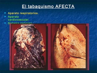 El tabaquismo AFECTA
   Aparato respiratorios.
   Aparato
    cardiovascular.
   Sistema nervioso.
 