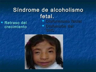 Síndrome de alcoholismo
                fetal.
   Retraso del
                     Disformismo facial
    crecimiento      Disfunción del
                      SNC
 