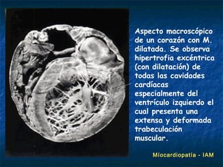 Aspecto macroscópico
de un corazón con M.
dilatada. Se observa
hipertrofia excéntrica
(con dilatación) de
todas las cavidades
cardíacas
especialmente del
ventrículo izquierdo el
cual presenta una
extensa y deformada
trabeculación
muscular.

     Míocardiopatía - IAM
 