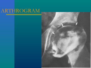 ARTHROGRAM
 