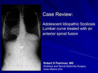Case Review:
      Adolescent Idiopathic Scoliosis
      Lumbar curve treated with an
      anterior spinal fusion


59°



      Robert S Pashman, MD
      Scoliosis and Spinal Deformity Surgery
      www.eSpine.com
 