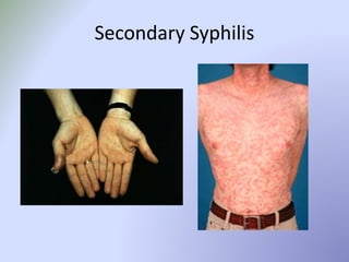 Secondary Syphilis
 